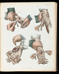 A treatise on operative surgery comprising a description of the various processes of the art, including all the new operations; exhibiting the state of surgical science in its present advanced condition; with eighty plates, containing four hundred and eighty-six separate illustrations. Second edition, revised and enlarged / by Joseph Pancoast.