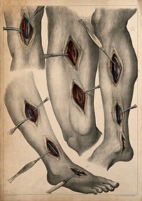 Surgery of blood vessels of the lower limb: four figures showing incisions in the leg and foot, with surgical instruments indicating blood vessels. Coloured lithograph by G.E. Madeley after A. A. Cane, 1834.