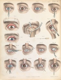 Plate XLIX. Various surgical treatments on the eye.