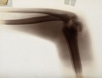 The fracture and dislocation of bones in an elbow joint, viewed through x-ray. Photoprint from radiograph after Sir Arthur Schuster, 1896.