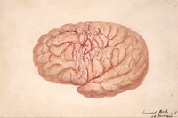 Left cerebral hemisphere of a child who died from tubercular meningitis