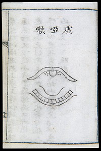 C18 Chinese woodcut: Deficiency-type hoarseness