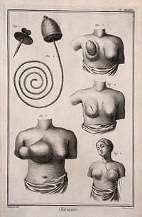 Surgery, top, instruments to perform a bronchostomy; below, breasts with tumours. Engraving with etching by B.L. Prevost after L.-J. Goussier.
