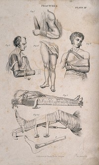Diagrams illustrating how to bandage and set fractures in splints. Engraving by J. Johnstone.
