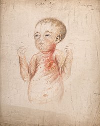A nine week old baby girl with diseased skin on her face, arms and body, displaying symptoms of hereditary syphilis. Watercolour by C. D'Alton, 1856.