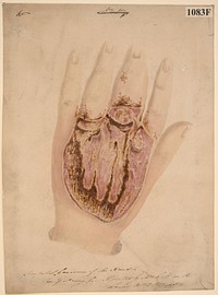 Hospital gangrene affecting the hand following a lancet puncture of an abscess