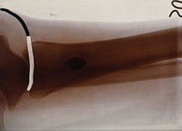 X-ray of a leg (shinbone ). Photograph, ca. 1900.