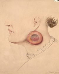 Unusual round-celled sarcoma occurring at the angle of the jaw of a woman
