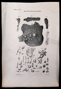 Several examples of diseased placenta, numbered for key. Lithograph by Ridolfi after Ottavio Muzzi, c. 1843.