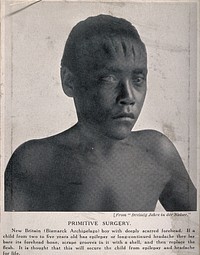 A boy with deep scars on his forehead as a result of surgery, in an attempt to cure epilepsy and headaches, Bismarck Archipelago (Papua New Guinea). Halftone.