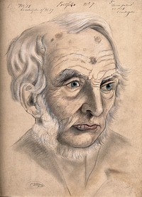 A man suffering from chancre of the lip, displaying scar tissue on his lower lip, forehead and scalp, shown after treatment and following the process of cicatrization. Watercolour by C. D'Alton, 1867.