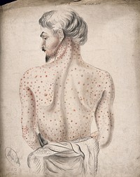 The back of a man suffering from a rash of sores. Watercolour by C. D'Alton, 1856.