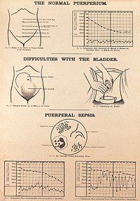 The normal puerperium, post-partum difficulties with the bladder, and puerperal sepsis. Lithograph after W. F. Victor Bonney.