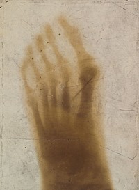 The bones of a pantomime artist's foot, viewed through x-ray; revealing a needle by one of the toes. Photoprint from radiograph after Sir Arthur Schuster, 1896.