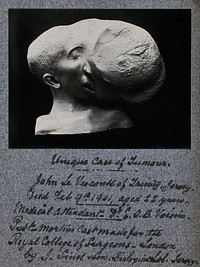 Tumour on the face of the patient John Le Visconte: a post-mortem head and shoulders plaster cast. Photograph, ca. 1901, of a plaster cast by J. Sinel & Son, 1901.