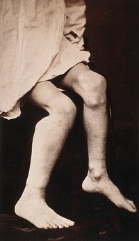 The legs of a child, showing deformity in the bones, particularly around the knee. Photograph by E. Peers.