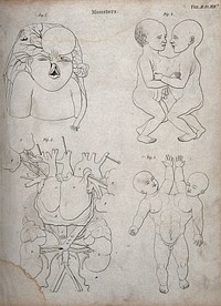 Two diagrams of conjoined twins, a foetus with a deformed head and face and an interior of a chest with two hearts. Line engraving.
