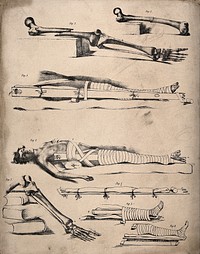 Methods of bandaging a broken leg: eight figures, showing femur and tibia bones broken at various points and the appropriate methods of applying bandages and splints. Lithograph, 18--.