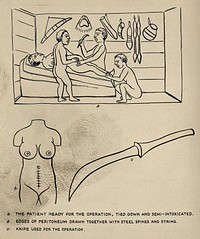 Caesarean section, Uganda: the patient being prepared for the operation; the sutured wound; the knife used. Ink drawing by S.W. Kelly, 1938, after R.W. Felkin, ca. 1884.