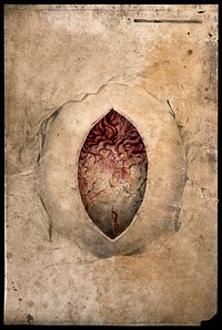 A tumour of the ovary cut open to show blood vessels. Watercolour, c. 1824.