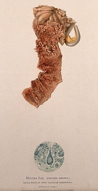 Dissection of a diseased intestine showing signs of cholera asiatica, with a detail showing a section as seen under a microscope. Chromolithograph by W. Gummelt, ca. 1897.