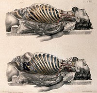 The body of a man lying down with the trunk dissected: two figures showing the lungs after breathing out (above) and after breathing in (below, simulated by inflating the lungs). Coloured lithograph by William Fairland, 1869.