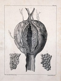A diseased part of the body. Lithograph by W. Walton after Franz Bauer.