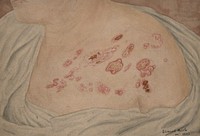 Upper chest and shoulder of a woman with skin eruption due to herpes zoster