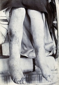 Friern Hospital, London: a child's legs and feet viewed from the knee down. Photograph, 1890/1910.