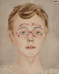 Face of a boy with a symmetrical eruption, possibly purpuric in nature