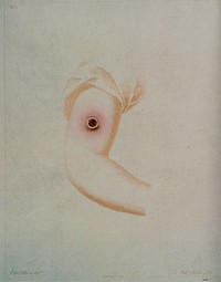 An arm with inflamed vaccine pustule. Coloured etching by W. Cuff and W. Skelton after E. Pearce.