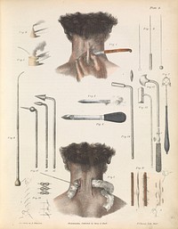 Plate VI. Various instruments and techniques used in surgery. Illustration of seton, moxa, acupuntcture needles, sutures, and cauteries.