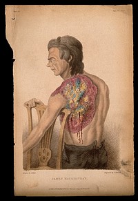 James M'Gillivray, a man shot in the shoulder in the siege of Nijmegen (1794): the shot developed into an ulcer which was cured by John Bell. Coloured stipple etching by J. Stewart after J. Bell, ca. 1826.