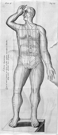 A treatise on acupuncturation; being a description of a surgical operation originally peculiar to the Japonese [sic] and Chinese, and by them denominated Zin-King, now introduced into European practice, with directions for its performance, and cases illustrating its success / [James Morss Churchill].