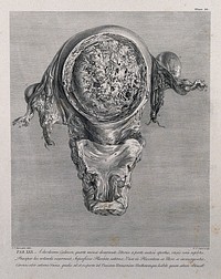 Dissection of the pregnant uterus at five months, showing the placenta and the cervix, in relation to the bladder and urethra. Copperplate engraving by P.C. Canot after J.V. Rymsdyk, 1774, reprinted 1851.