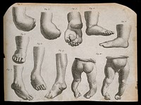 Deformed feet and ankles: 10 figures. Line and stipple engraving, 1770/1830.