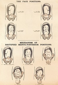 The face positions and the mechanism of rectified mento-posterior positions in childbirth. Lithograph after W. F. Victor Bonney.