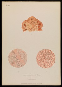 Illustrations of pathological anatomy : being a series of chromographed plates painted from nature immediately after death / with descriptive text by Alfred Kast and Theodor Rumpel ; English edition, revised and edited by M. Armand Ruffer.