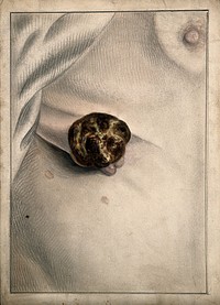 A tumour on the torso of a young woman. Watercolour by C. D'Alton, 1870.