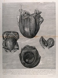 Dissections of a retroverted pregnant uterus, shown with the bladder, at five months: two figures. Copperplate engraving by Aliamet after J.V. Rymsdyk, 1774, reprinted 1851.