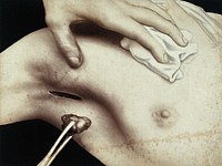 A breast operation to remove a lump, in progress: metal surgical tongs hold a lump taken from the breast via an incision in the armpit. Photograph by Félix Méheux, ca. 1900.