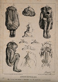 Malformed foetuses and skeletons with part of the brain missing. Lithograph by Meunier, 1826.