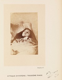 Iconographie photographique de la Salpêtrière : service de M. Charcot / par Bourneville et P. Regnard.