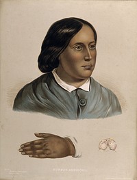 Face and hand of a woman suffering from morbus addisonii (bronzed skin disease), with a detail showing an unidentified organ . Chromolithograph after W. Hurst, 1850/1880.