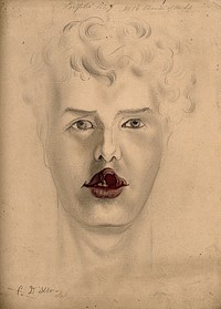 Face of a man suffering from chancre of the lip. Watercolour by C. D'Alton, 1867.