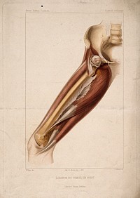 A dislocated femur bone: dissection of the thigh, showing the bone and surrounding muscles. Coloured stipple engraving by Debray after Bion, ca. 1870.