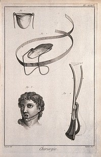 Surgery: surgical instruments, including a bandage for the tongue. Engraving with etching by A.J. Defehrt after L.-J. Goussier.
