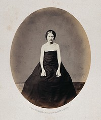 A woman standing, viewed from the front, her shoulders and arms are unclothed and she has misshapen fingers. Photograph by L. Haase after H.W. Berend, 1862.