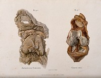 Sections of two knee joints: left, bone affected by arthropathy, right, an inflamed knee joint. Chromolithograph by W. Gummelt, ca. 1897.