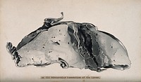 Dissection of the liver, showing an old subcapsular laceration. Ink wash drawing by G. Dorman, ca. 1910.